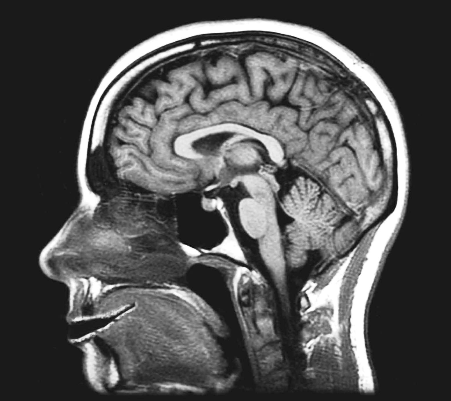 Фото снимок МРТ головного мозга здорового человека (норма)