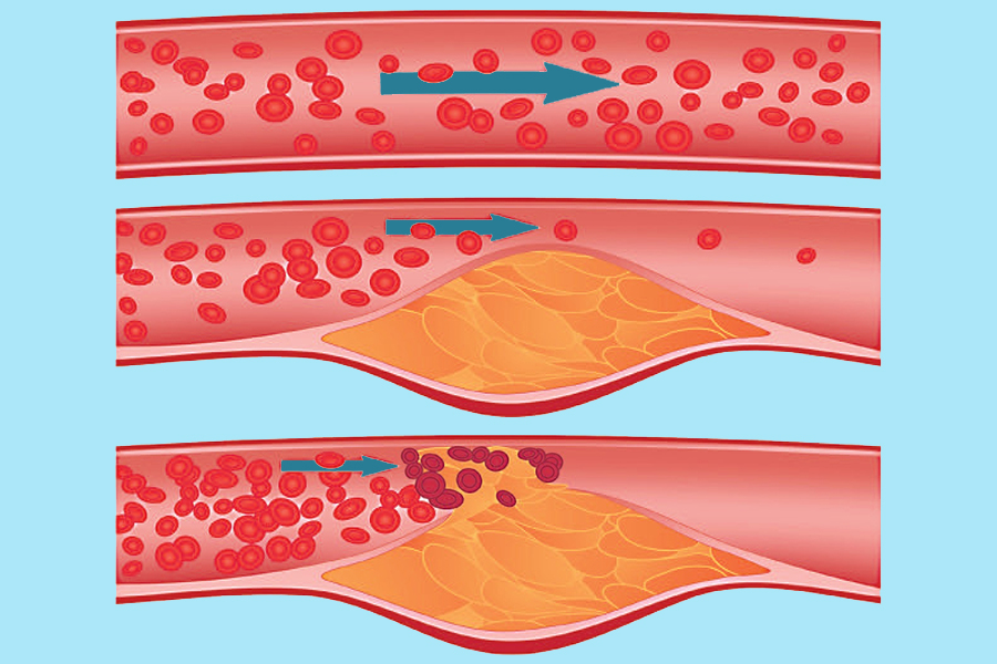 ateroskleroz-sosudov