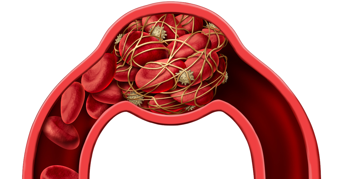 Blood clot disease symbol and thrombosis medical 3D illustration concept as a group of human blood cells clumped together by sticky platelets and fibrin creating a blockage in an artery or vein as a health disorder.